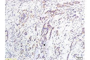 Formalin-fixed and paraffin embedded human pancreatic cancer labeled with Anti-EDG2/LPA1 Polyclonal Antibody, Unconjugated (ABIN681103) at 1:400 followed by conjugation to the secondary antibody and DAB staining (LPAR1 抗体  (AA 281-364))