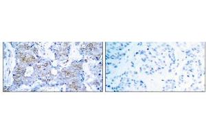 Immunohistochemical analysis of paraffin- embedded human breast carcinoma tissue using HER2 (Ab-1248) antibody (E021072). (ErbB2/Her2 抗体)