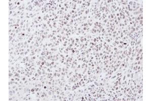 IHC-P Image Immunohistochemical analysis of paraffin-embedded SCM-1 xenograft, using Chk1, antibody at 1:100 dilution. (CHEK1 抗体)