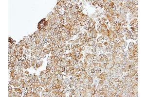 IHC-P Image Immunohistochemical analysis of paraffin-embedded TOV-112D xenograft, using JAM-B, antibody at 1:100 dilution. (JAM2 抗体)