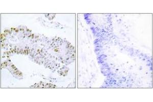 Immunohistochemistry analysis of paraffin-embedded human colon carcinoma tissue, using ERF (Ab-526) Antibody. (ERF 抗体  (AA 492-541))