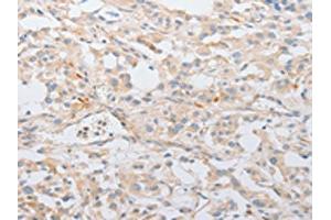 The image on the left is immunohistochemistry of paraffin-embedded Human thyroid cancer tissue using ABIN7131038(SERPINE2 Antibody) at dilution 1/20, on the right is treated with fusion protein. (SERPINE2 抗体)