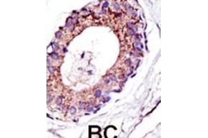 Formalin-fixed and paraffin-embedded human cancer tissue reacted with the primary antibody, which was peroxidase-conjugated to the secondary antibody, followed by DAB staining. (UBE4A 抗体  (C-Term))