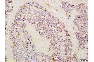 Formalin-fixed and paraffin embedded human thyroid cancer labeled with Anti-IL-21 Polyclonal Antibody, Unconjugated (ABIN748133) at 1:200 followed by conjugation to the secondary antibody and DAB staining (IL-21 抗体  (AA 65-155))