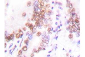 Immunohistochemistry analysis with EP300 / P300 antibody in paraffin-embedded human lung carcinoma tissue. (p300 抗体)