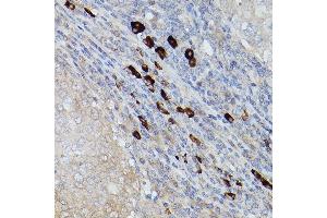 Immunohistochemistry of paraffin-embedded human breast cancer using UBE2L6 Rabbit pAb (ABIN1683197, ABIN3018773, ABIN3018774 and ABIN7101658) at dilution of 1:250 (40x lens). (UBE2L6 抗体)