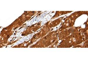Immunohistochemistry of paraffin-embedded Human breast cancer tissue using LIPG Polyclonal Antibody at dilution of 1:50(x200) (LIPG 抗体)