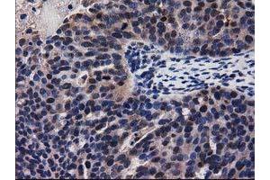 Immunohistochemical staining of paraffin-embedded Carcinoma of Human kidney tissue using anti-ADSL mouse monoclonal antibody. (Adenylosuccinate Lyase 抗体)