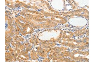 The image on the left is immunohistochemistry of paraffin-embedded Human thyroid cancer tissue using ABIN7189848(APOB Antibody) at dilution 1/10, on the right is treated with synthetic peptide. (APOB 抗体)