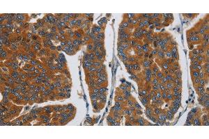 Immunohistochemistry of paraffin-embedded Human breast cancer using APEH Polyclonal Antibody at dilution of 1:30 (APEH 抗体)