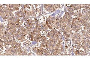 ABIN6268679 at 1/100 staining Human Melanoma tissue by IHC-P. (IL12A 抗体  (Internal Region))