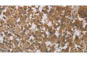 Immunohistochemistry of paraffin-embedded Human thyroid cancer using Cytochrome b5 Polyclonal Antibody at dilution of 1:40 (Cytochrome b5 (CYTB5) 抗体)