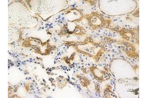 ABIN6256416 and ABIN6267653 at 1/100 staining human thyroid carcinoma by IHC-P. (PKD1/2/3/PKC mu (pSer738), (pSer742) 抗体)