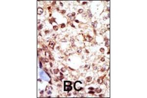 Formalin-fixed and paraffin-embedded human cancer tissue reacted with the primary antibody, which was peroxidase-conjugated to the secondary antibody, followed by AEC staining. (Fgr 抗体  (N-Term))