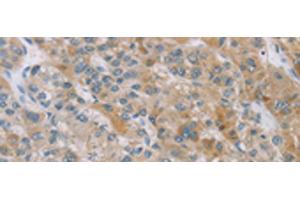 Immunohistochemistry of paraffin-embedded Human liver cancer tissue using ZAK Polyclonal Antibody at dilution of 1:100(x200) (ZAK 抗体)