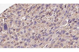 ABIN6272277 at 1/100 staining Human Melanoma tissue by IHC-P.