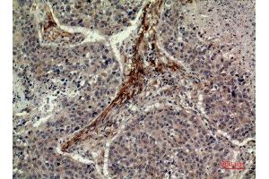 Immunohistochemistry (IHC) image for anti-Isocitrate Dehydrogenase 1 (NADP+), Soluble (IDH1) (N-Term) antibody (ABIN3187915)
