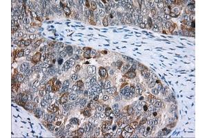 Immunohistochemical staining of paraffin-embedded Adenocarcinoma of Human colon tissue using anti-CD5 mouse monoclonal antibody. (CD5 抗体)