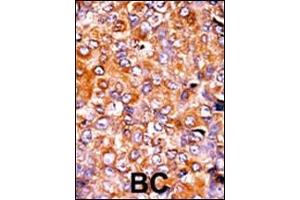 Formalin-fixed and paraffin-embedded human cancer tissue reacted with the primary antibody, which was peroxidase-conjugated to the secondary antibody, followed by AEC staining. (MYT1 抗体  (pThr495))