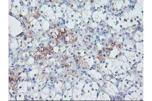Immunohistochemical staining of paraffin-embedded Carcinoma of Human kidney tissue using anti-SERPINE2 mouse monoclonal antibody. (SERPINE2 抗体)