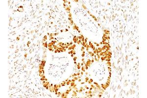 Formalin-fixed, paraffin-embedded human Colon Carcinoma stained with p27 Mouse Monoclonal Antibody (SX53G8).
