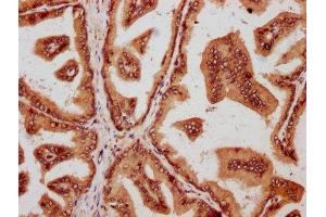 IHC image of ABIN7160228 diluted at 1:600 and staining in paraffin-embedded human prostate tissue performed on a Leica BondTM system. (SMAD2 抗体  (AA 2-467))