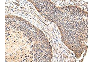 The image on the left is immunohistochemistry of paraffin-embedded Human esophagus cancer tissue using ABIN7128081(VIL1 Antibody) at dilution 1/30, on the right is treated with fusion protein. (Villin 1 抗体)