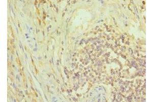Immunohistochemistry of paraffin-embedded human colon cancer using ABIN7149352 at dilution of 1:100 (NCK1 抗体  (AA 58-377))