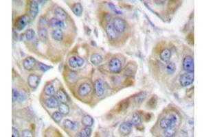 Immunohistochemistry analyzes of Integrin β4 antibody in paraffin-embedded human breast carcinoma tissue. (Integrin beta 4 抗体)