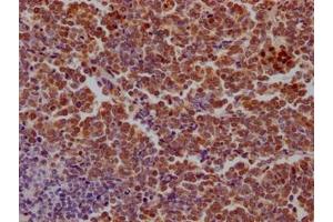IHC image of ABIN7149714 diluted at 1:100 and staining in paraffin-embedded human lung cancer performed on a Leica BondTM system. (SAMHD1 抗体  (AA 1-314))