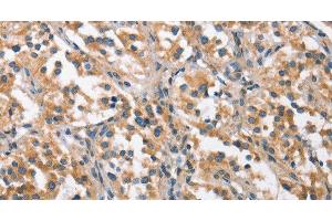 Immunohistochemistry of paraffin-embedded Human thyroid cancer using CHMP1A Polyclonal Antibody at dilution of 1:60 (CHMP1A 抗体)
