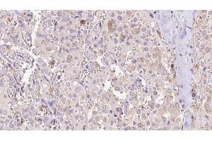 ABIN6273314 at 1/100 staining Human thyroid cancer tissue by IHC-P. (EXOC3 抗体  (Internal Region))
