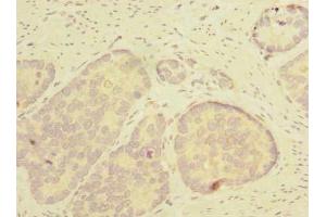 Immunohistochemistry of paraffin-embedded human gastric cancer using ABIN7171988 at dilution of 1:100 (THTPA 抗体  (AA 2-230))