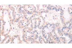 Immunohistochemistry of paraffin-embedded Human thyroid cancer using TRAF3IP1 Polyclonal Antibody at dilution of 1:70 (TRAF3IP1 抗体)