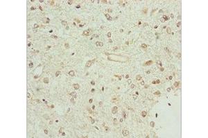 Immunohistochemistry of paraffin-embedded human glioma using ABIN7159847 at dilution of 1:100 (BCS1L 抗体  (AA 33-240))
