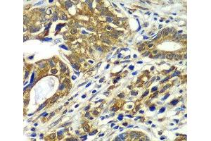Immunohistochemistry of paraffin-embedded Human gastric cancer using CDC16 Polyclonal Antibody at dilution of 1:100 (40x lens). (CDC16 抗体)