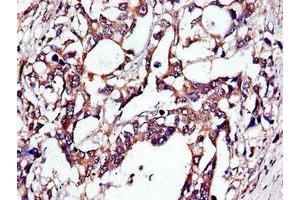 Immunohistochemistry of paraffin-embedded human gastric cancer using ABIN7173671 at dilution of 1:100 (TUBA4A 抗体  (AA 20-183))