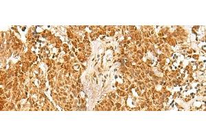 Immunohistochemistry of paraffin-embedded Human lung cancer tissue using SSSCA1 Polyclonal Antibody at dilution of 1:50(x200) (SSSCA1 抗体)