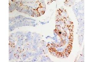 Immunohistochemical analysis of paraffin-embedded mammary cancer sections, staining MORG1 in cytoplasm, DAB staining (MORG1 抗体  (N-Term))