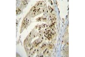 Immunohistochemistry analysis in formalin fixed and paraffin embedded human prostate carcinoma reacted with AP53159PU-N, which was peroxidase conjugated to the secondary antibody and followed by DAB staining. (PAPOLA 抗体  (Middle Region))