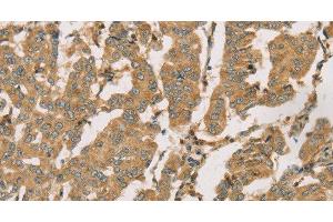 Immunohistochemistry of paraffin-embedded Human breast cancer using DMRT3 Polyclonal Antibody at dilution of 1:50 (DMRT3 抗体)