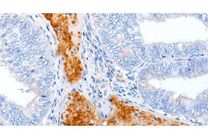 Immunohistochemistry of paraffin-embedded Human cervical cancer using ENPP7 Polyclonal Antibody at dilution of 1:50 (ENPP7 抗体)