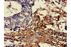 Immunohistochemistry of paraffin-embedded human gastric cancer using ABIN7149454 at dilution of 1:100 (DDO 抗体  (AA 37-161))
