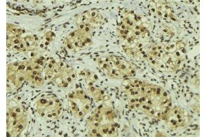 ABIN6267184 at 1/100 staining Human breast cancer tissue by IHC-P.