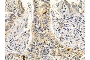 DNALI1 Mouse Monoclonal Antibody at 1/100 staining human lung cancer and adjacent non-tumor tissue by IHC-P. (DNALI1 抗体)