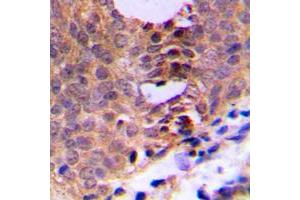 Immunohistochemical analysis of CDC2 (pT161) staining in human breast cancer formalin fixed paraffin embedded tissue section.