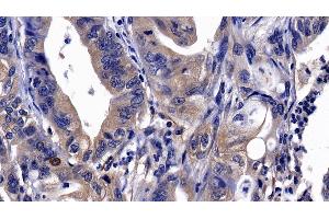 Detection of ITGaV in Human Stomach cancer Tissue using Polyclonal Antibody to Integrin Alpha V (ITGaV) (CD51 抗体  (AA 560-744))