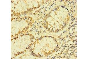 Immunohistochemistry of paraffin-embedded human colon cancer using ABIN7142550 at dilution of 1:100 (FAU 抗体  (AA 1-59))