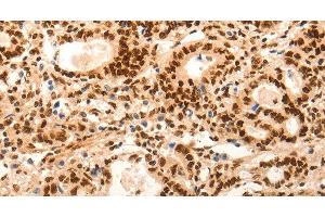 Immunohistochemistry of paraffin-embedded Human gasrtic cancer tissue using E2F7 Polyclonal Antibody at dilution 1:60 (E2F7 抗体)
