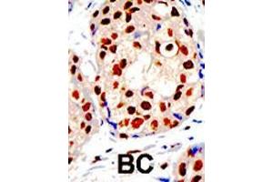 Formalin-fixed and paraffin-embedded human cancer tissue reacted with the primary antibody, which was peroxidase-conjugated to the secondary antibody, followed by DAB staining. (PRMT1 抗体  (C-Term))